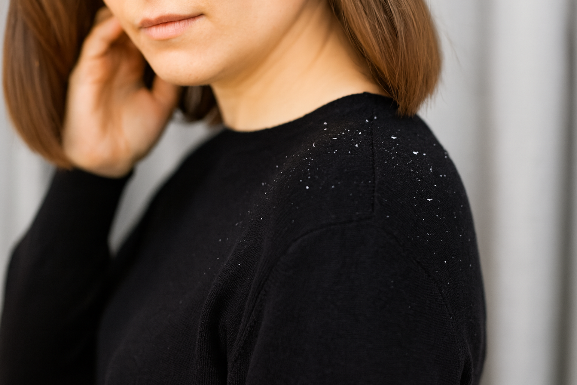 What Causes Dandruff?